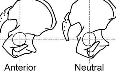 5 Exercises to Reduce Anterior Pelvic Tilt