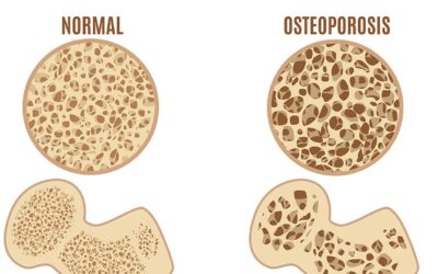 Prevent Osteoporosis with Aligned Posture