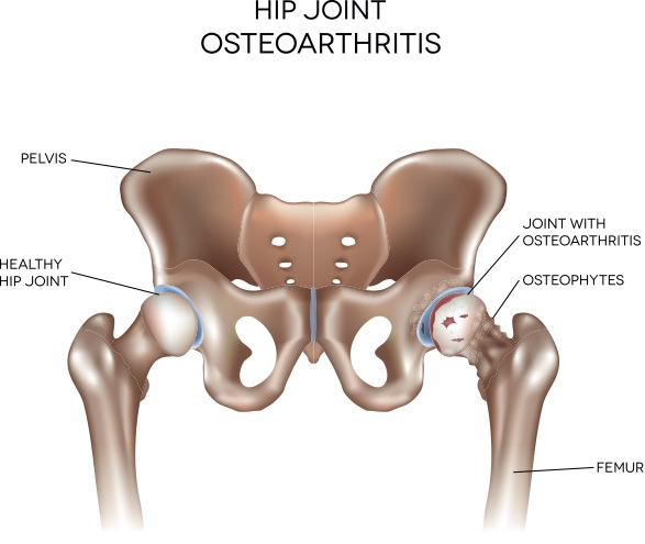 The Pain Free Athlete :: Hip Joint