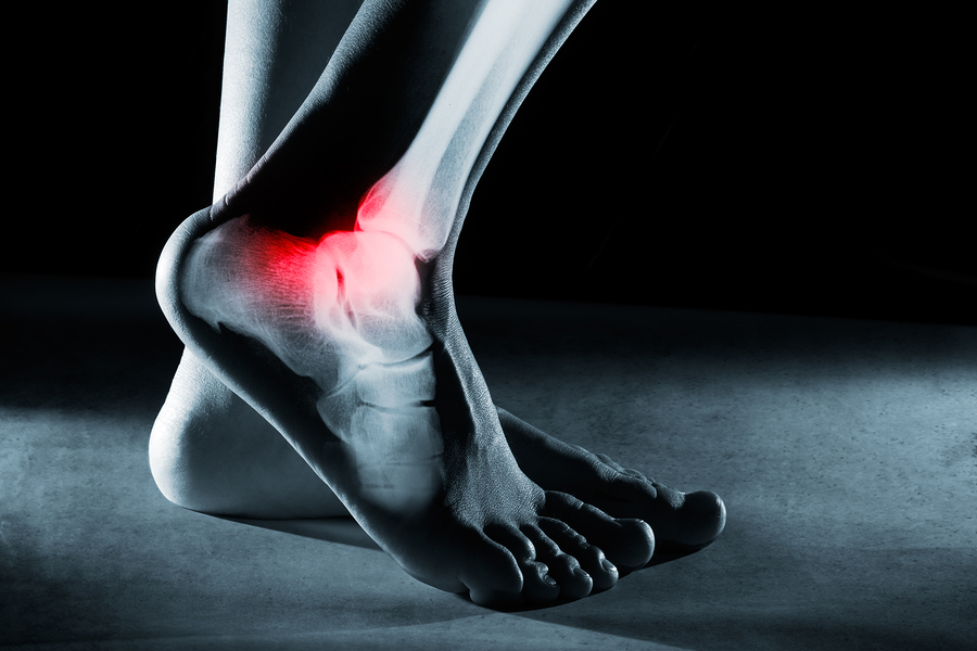 Foot and Ankle Injuries Often Lead to Chronic Pain