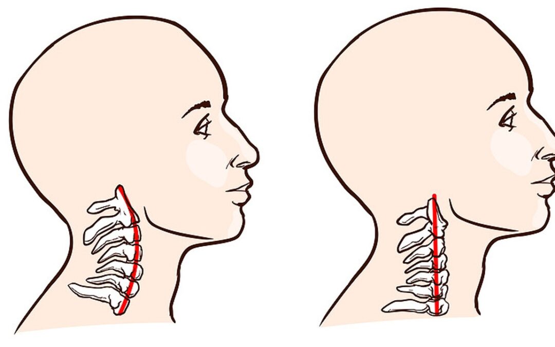 Neck Pain and Posture